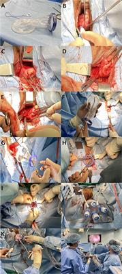 Hysterectomy and Adnexal Procedures by Vaginal Natural Orifice Transluminal Endoscopic Surgery (VNH): Initial Findings From a Korean Surgeon
